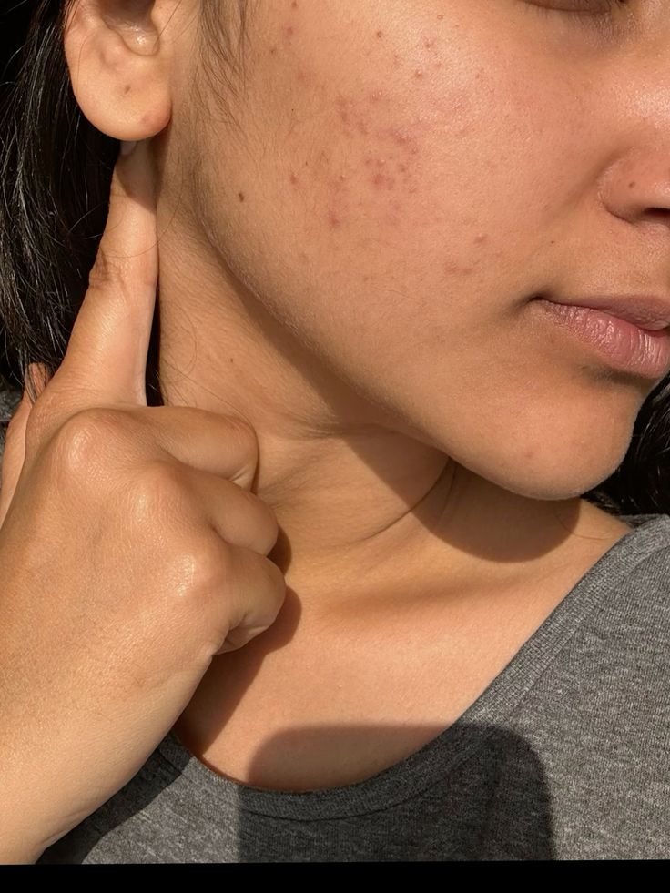 Laser treatment device targeting hyperpigmentation